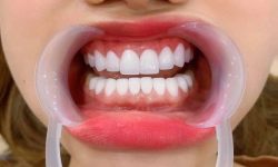 Quy trình trồng răng sứ đúng chuẩn giúp ngăn ngừa viêm nhiễm