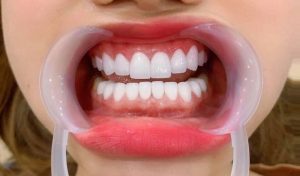 Quy trình trồng răng sứ đúng chuẩn giúp ngăn ngừa viêm nhiễm