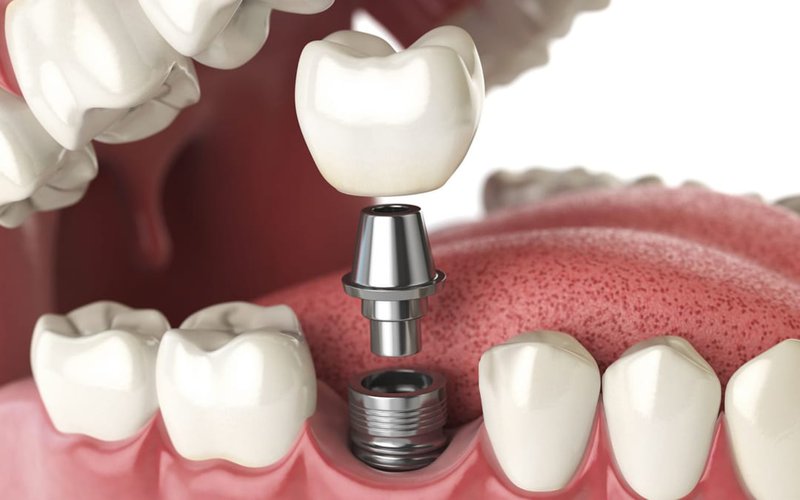 Trồng răng là phương pháp phục hình nha khoa phổ biến