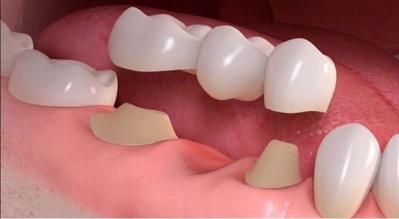 Cầu răng sứ là phương pháp phục hình một hoặc nhiều răng đã mất