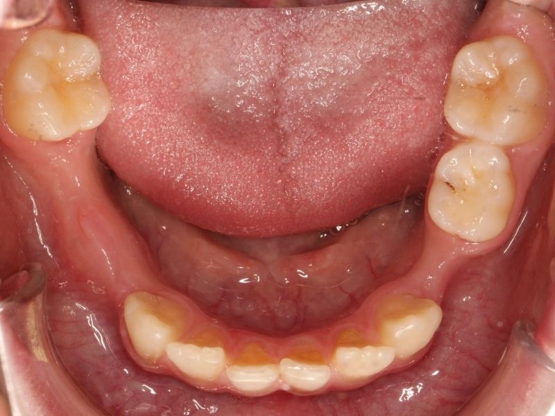 Người bị mất một hay nhiều răng có thể chọn cấy ghép Implant