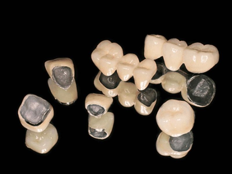 Răng sứ kim loại thường có giá rẻ nhất hiện nay