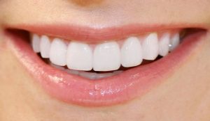 Trồng răng sứ nguyên hàm phục hình nha khoa hiệu quả