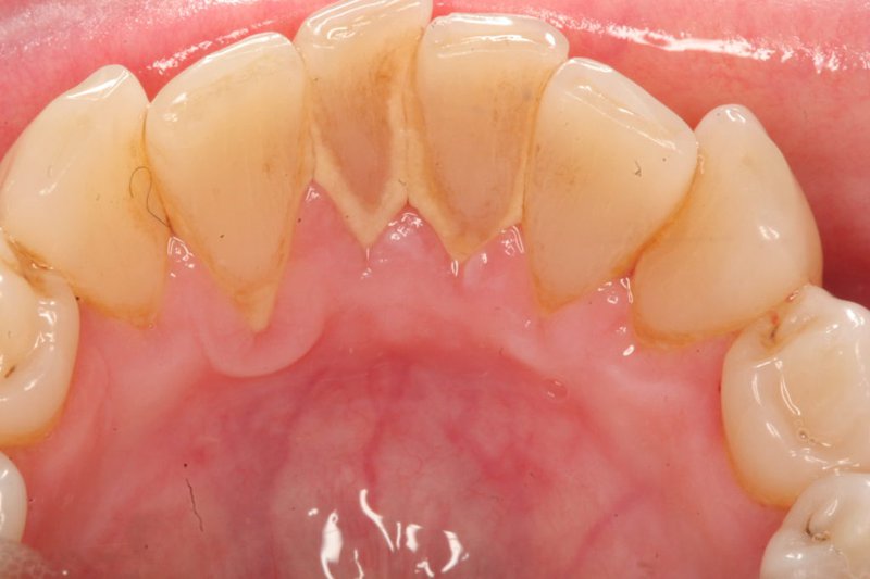 Lấy cao răng tại nhà chỉ thích hợp với trường hợp ít vôi răng