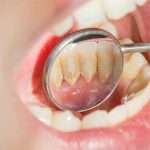 Lấy cao răng xong bị buốt răng là hiện tượng thường gặp