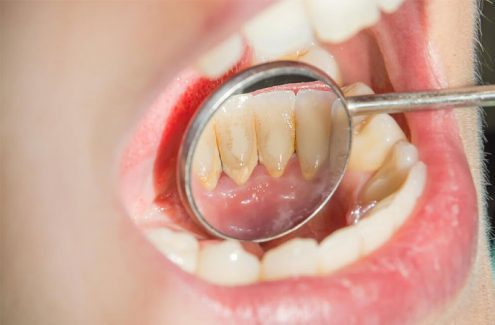 Lấy cao răng xong bị buốt răng là hiện tượng thường gặp