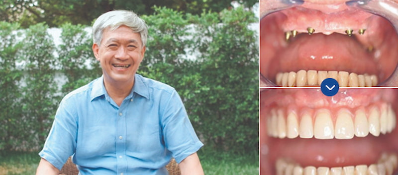 Hình ảnh khách hàng trước và sau khi trồng răng Implant