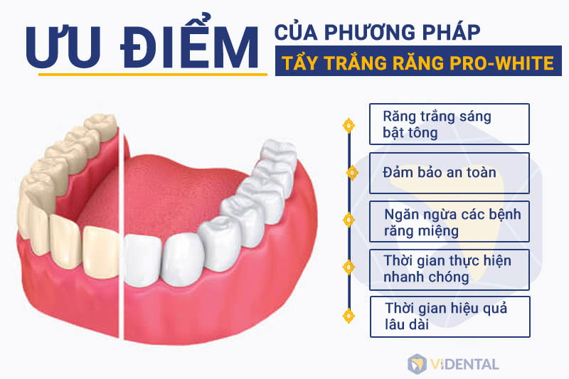 Ưu điểm của phương pháp tẩy trắng răng PRO-WHITE.