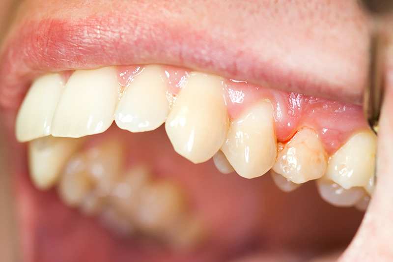 Viêm lợi nguy hiểm hơn bạn vẫn nghĩ!