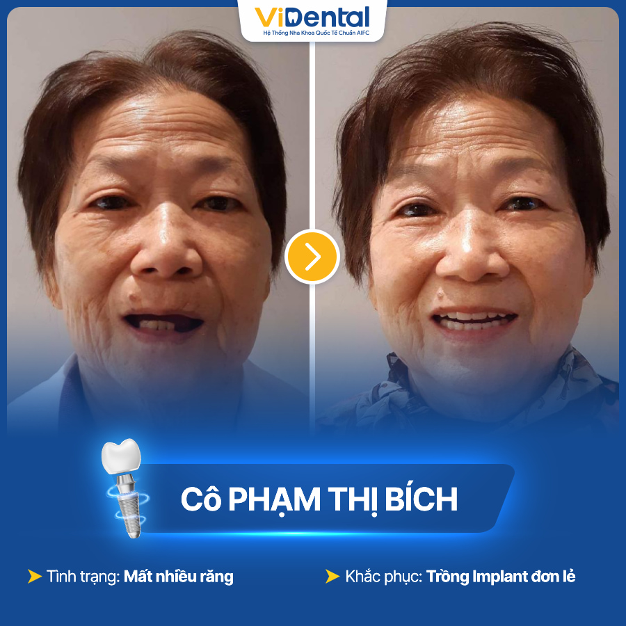 Cô Bích trước và sau khi trồng răng Implant tại ViDental